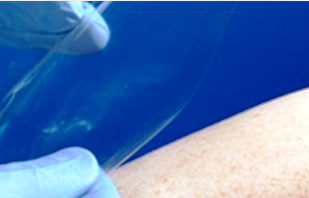 Innocoll CollaCare Collagen Film